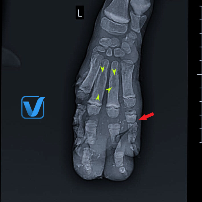 Radiology, Osteolysis, Soft tissue swelling, Dog, Manus (Forepaw).
